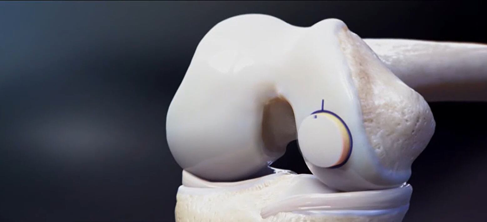 Back in the Game! New Hope for Complex Knee Surgeries - Vimarsana News